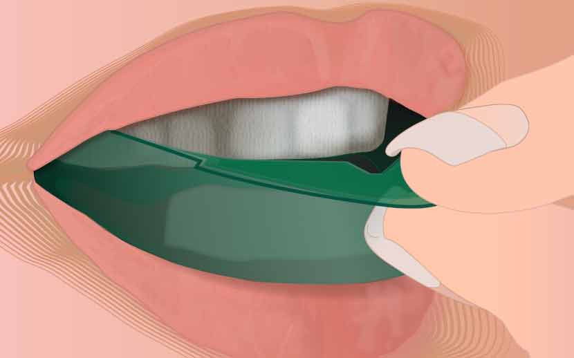 Blanqueamiento Casero - Opalescence Go 1 Caja x 20 Cubetas( 10 sup, 10 inf)